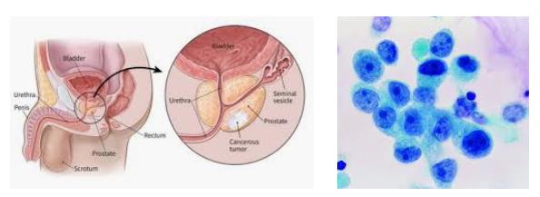 攝護腺癌