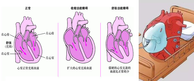 心力衰竭