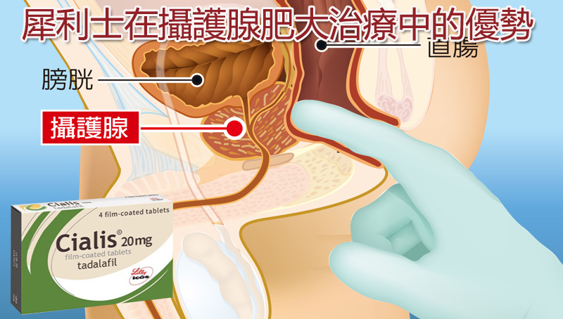 犀利士在攝護腺肥大治療中的優勢 犀利士在攝護腺肥大治療中的優勢