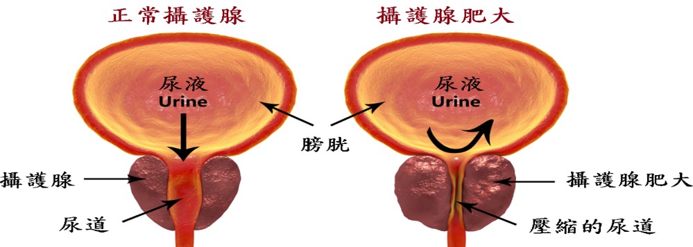 什麼是攝護腺肥大? 什麼是攝護腺肥大?